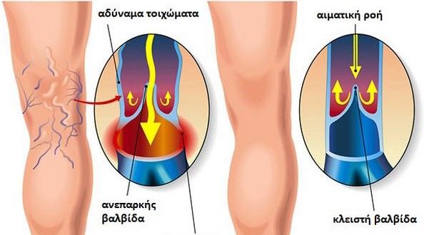 Απαλλαγείτε με φυσικούς τρόπους   Φλεβίτιδα